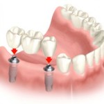 dental-implants-300x222