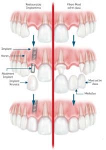 zubnih implantata