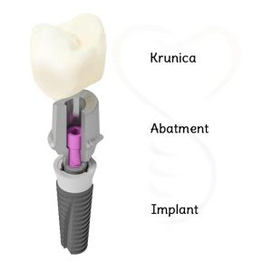 o zubnim implantima