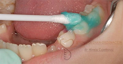 Fluorisanje zuba